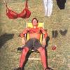 Sunburn